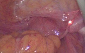 腹腔鏡を併用する場合