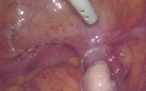 腹腔鏡を併用する場合
